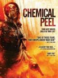 Chemical Peel